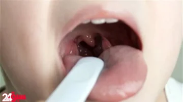 التغذية بعد استئصال اللوز.. قائمة أطعمة تعجل الشفاء وتخفف الألم لدى طفلك